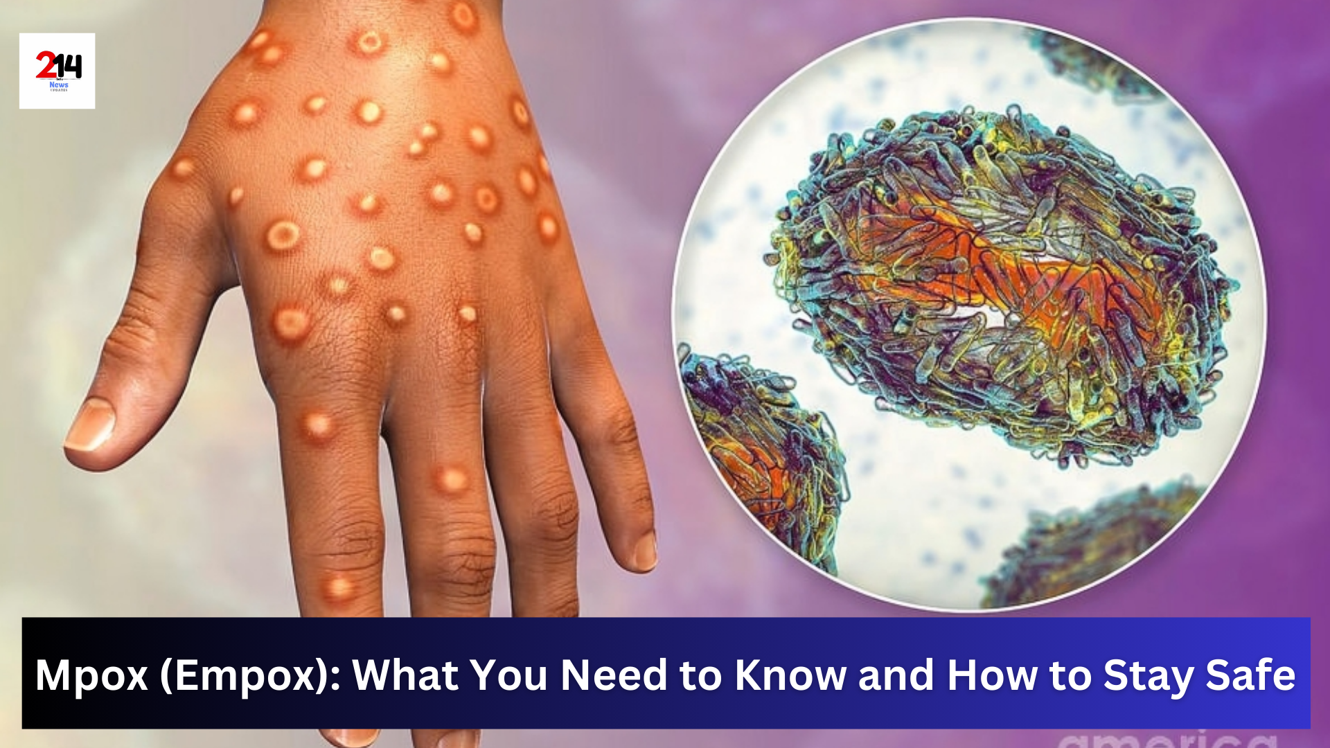 Learn about Mpox (Empox), its symptoms, how it spreads, and simple steps to protect yourself and others. Stay informed and safe with this easy-to-understand guide.